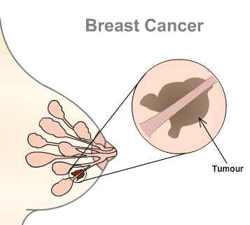 Breast cancer, as the name