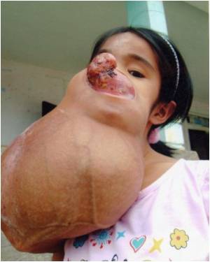 http://www.medindia.net/afp/images/US-Vietnam-health-tumor-21112.jpg