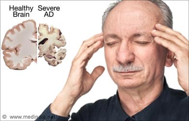 Health Benefits of Turmeric: Alzheimer's Disease