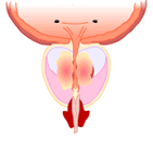 Learn about Enlarging Prostate Gland