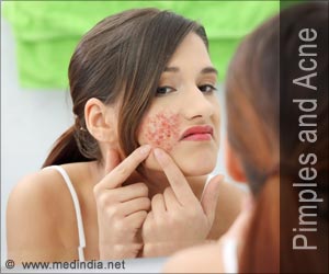 Pimples and Acne - Beauty Tips