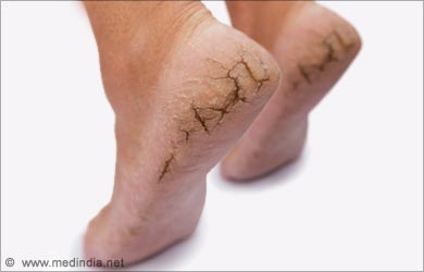 skin cancer on feet #9