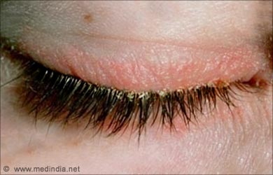 Dry Patch Of Skin Above Eye