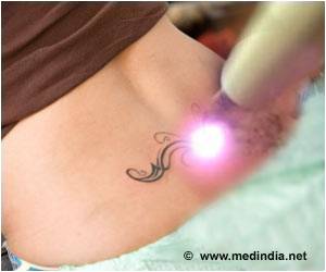 Tattoo Removal Could Turn Easier With New Laser Therapies