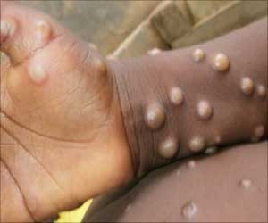 Japan Approves Smallpox Vaccine for Monkeypox