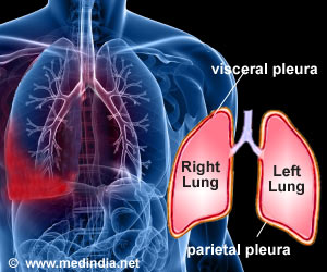 What is the treatment for pleurisy?