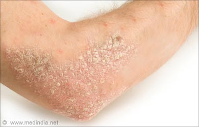 Spider Bites: Symptoms, Treatment, and How to Identify