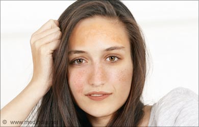 Skin Pigmentation Disorders