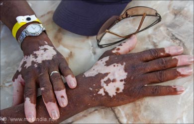 Vitiligo and Loss of Skin Color - WebMD
