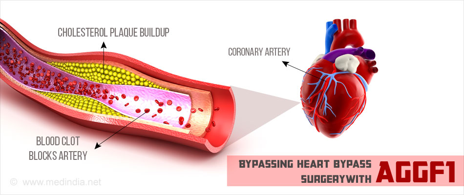 What is heart bypass surgery?