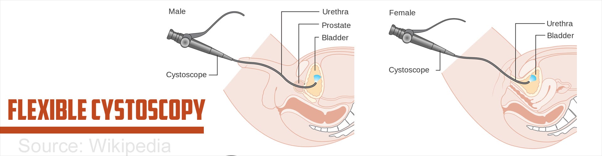 How is a cystoscopy done?