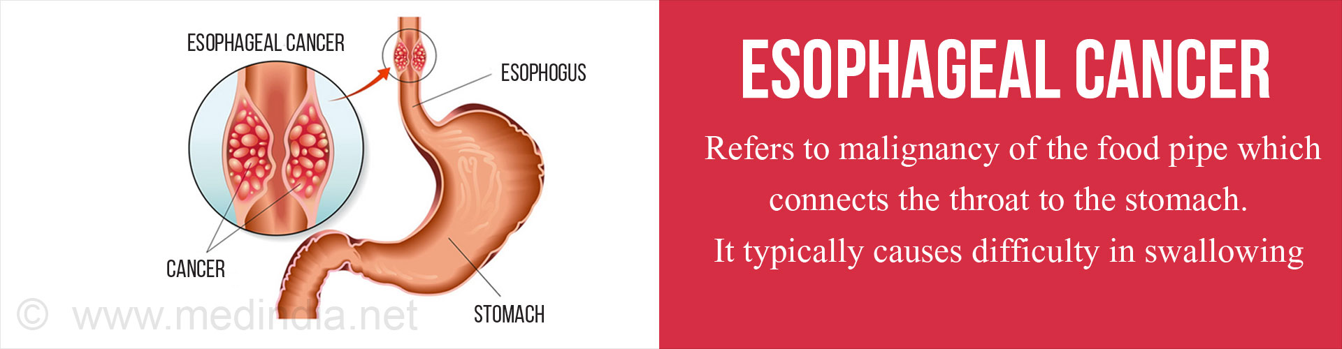 What are the symptoms of esophageal cancer?