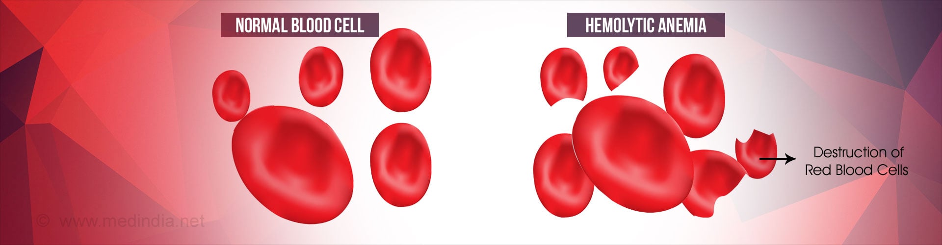What are some symptoms of hemolytic anemia?