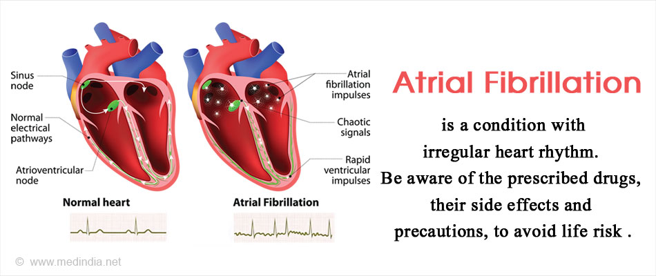 Drugs For Atrial Fibrillation Symptoms Treatment Side Effects