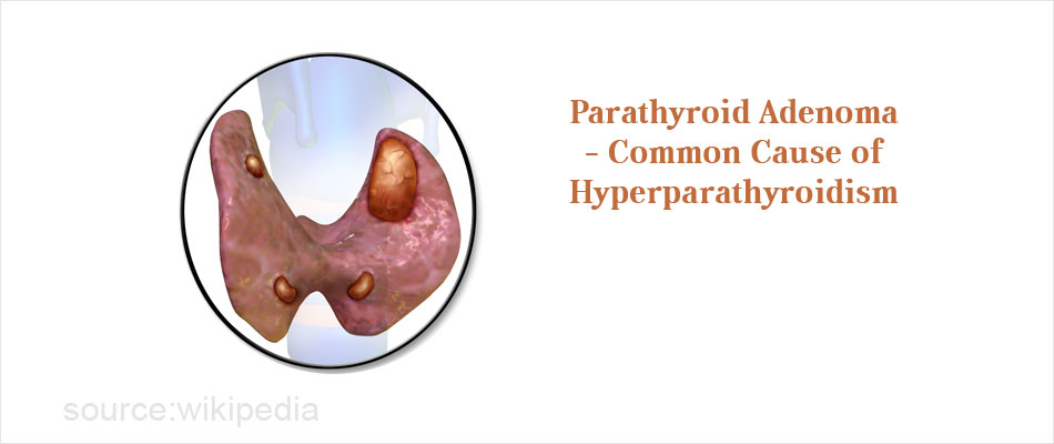 What are the signs and symptoms of parathyroid disease?