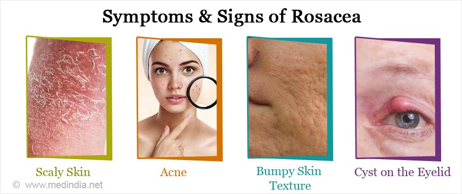 Symptoms & Signs of Rosacea