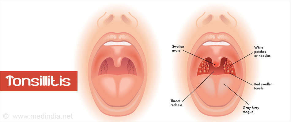 Strep Throat Ketosis Breath 59