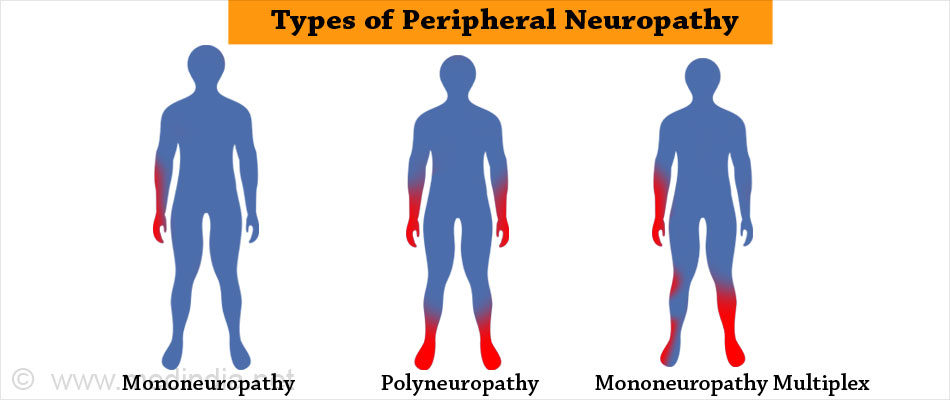 What is peripheral neuropathy?