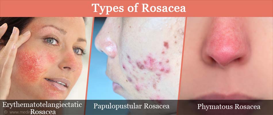 Types of Rosacea