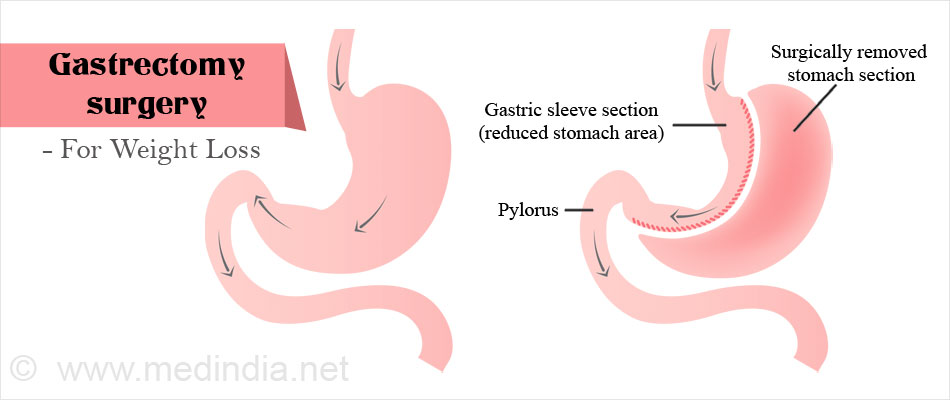 Gastrectomy Diet Modifications For Pancreatitis