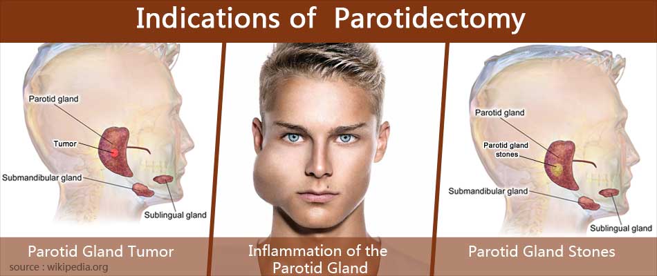 Parotidectomy Print