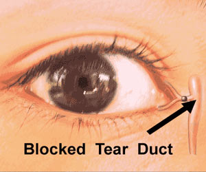 Blocked Tear Duct - Causes - Symptoms - Diagnosis - Treatment - FAQs