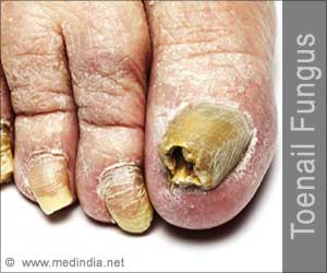 Toenail Fungus - Causes Symptoms Diagnosis Treatment Complications