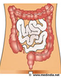 colon inflammation