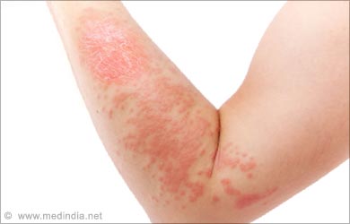 Fenugreek Natural Remedies: Skin Allergy