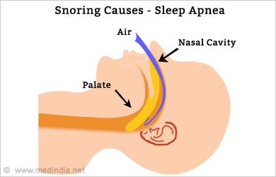 snoring-sleep-apnea.jpg