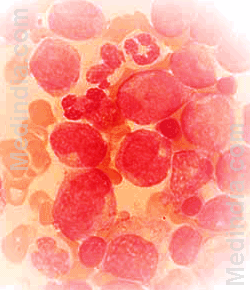 Acute Leukemia Cells