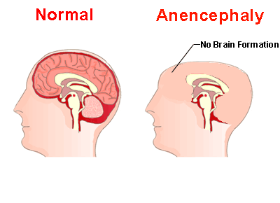 Structural Defects - ANENCEPHALY | Medindia