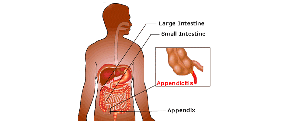What Causes Appendix To Burst In Children