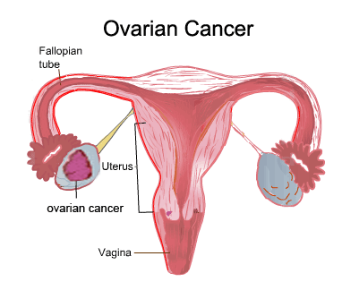Surviving Ovarian CAncer: Rutgers Scientists Attack Drug Resistant Cancer Cells