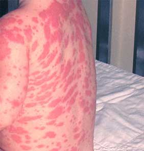 Hives Allergic Reaction Treatment in Germany