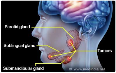 Salivary Gland Cancer Causes Types Symptoms Diagnosis Treatment Faqs.