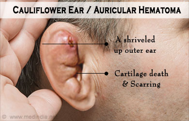 Image result for cauliflower ear causes, symptoms & treatments