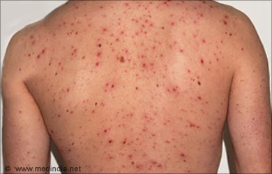Help for Skin Rashes Including Pictures and Descriptions