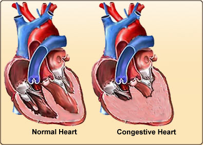 Prevent premature deaths from heart failure
