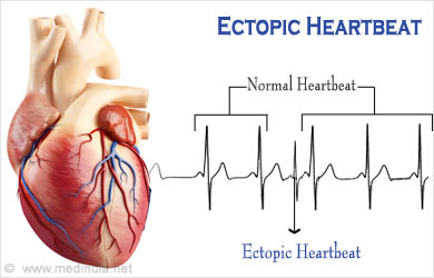 ectopic heartbeat common causes symptoms harmless usually cause changes clear types which there these two