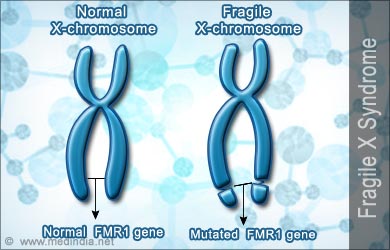 New genetic clues found in fragile X syndrome 