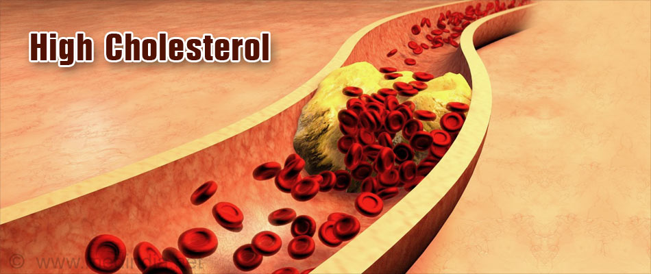 High Cholesterol | Hypercholesterolemia - Causes, Symptoms ...
