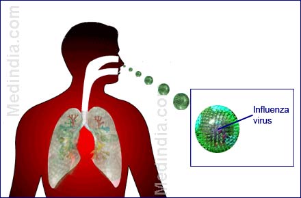 influenza symptoms