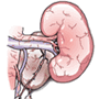 Pyeloplasty of Kidney