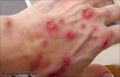 Small Blisters on the Hands & Feet | LIVESTRONG.COM