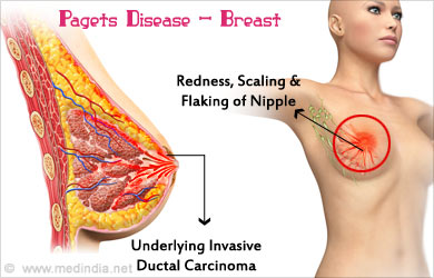 Itchy Breast or Nipple - Healthline