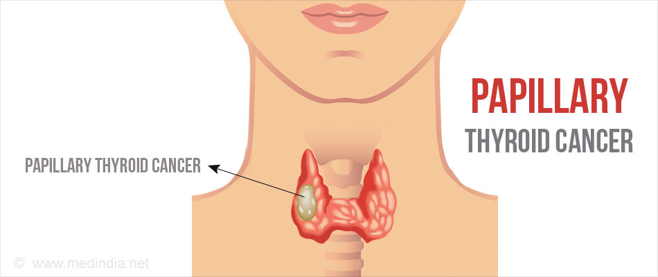 What are some symptoms of papillary thyroid carcinoma?