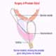 Endoscopic Prostate Surgery- TURP