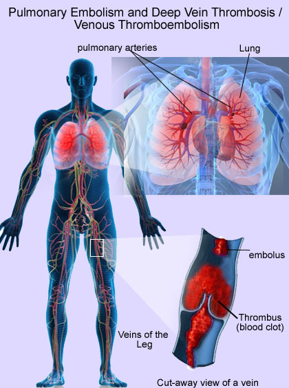 Pulmonary Embolism and Deep Vein Thrombosis / Venous Thromboembolism