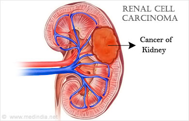 NCCS pioneers new drug regimen which reduces toxicities for renal cancer patients